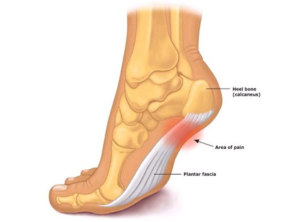 Plantar-Fasciitis